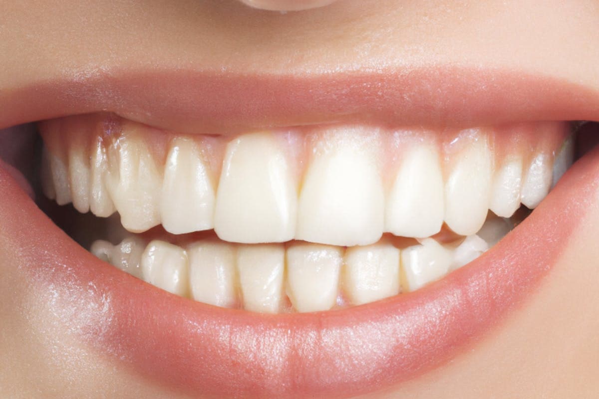How Long Does Teeth Whitening Last