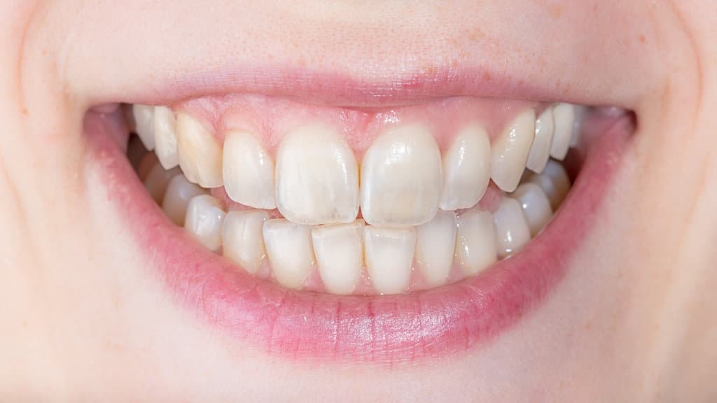 Enamel Erosion Stages