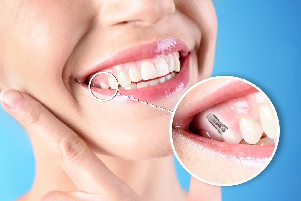 Are Dental Implants Safe