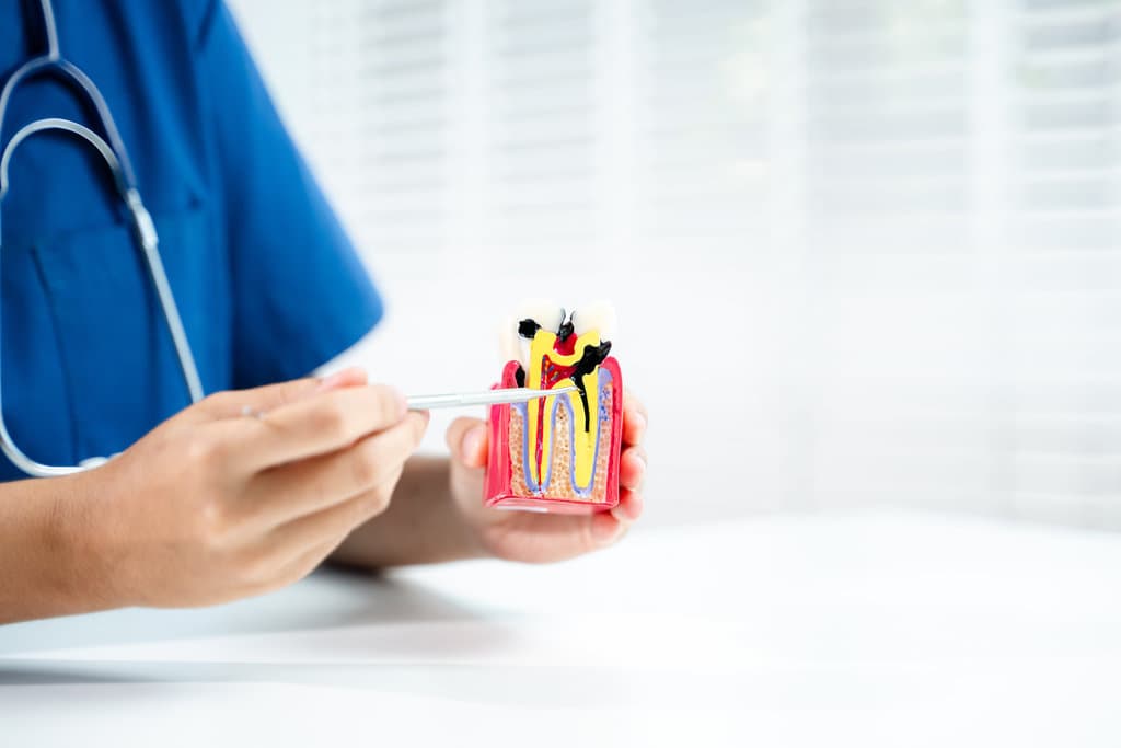 Alternatives to Root Canal