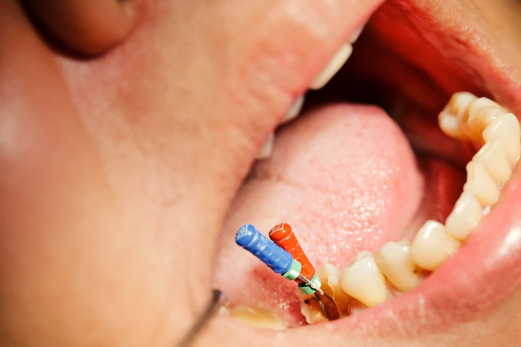 Are Root Canals Worth It
